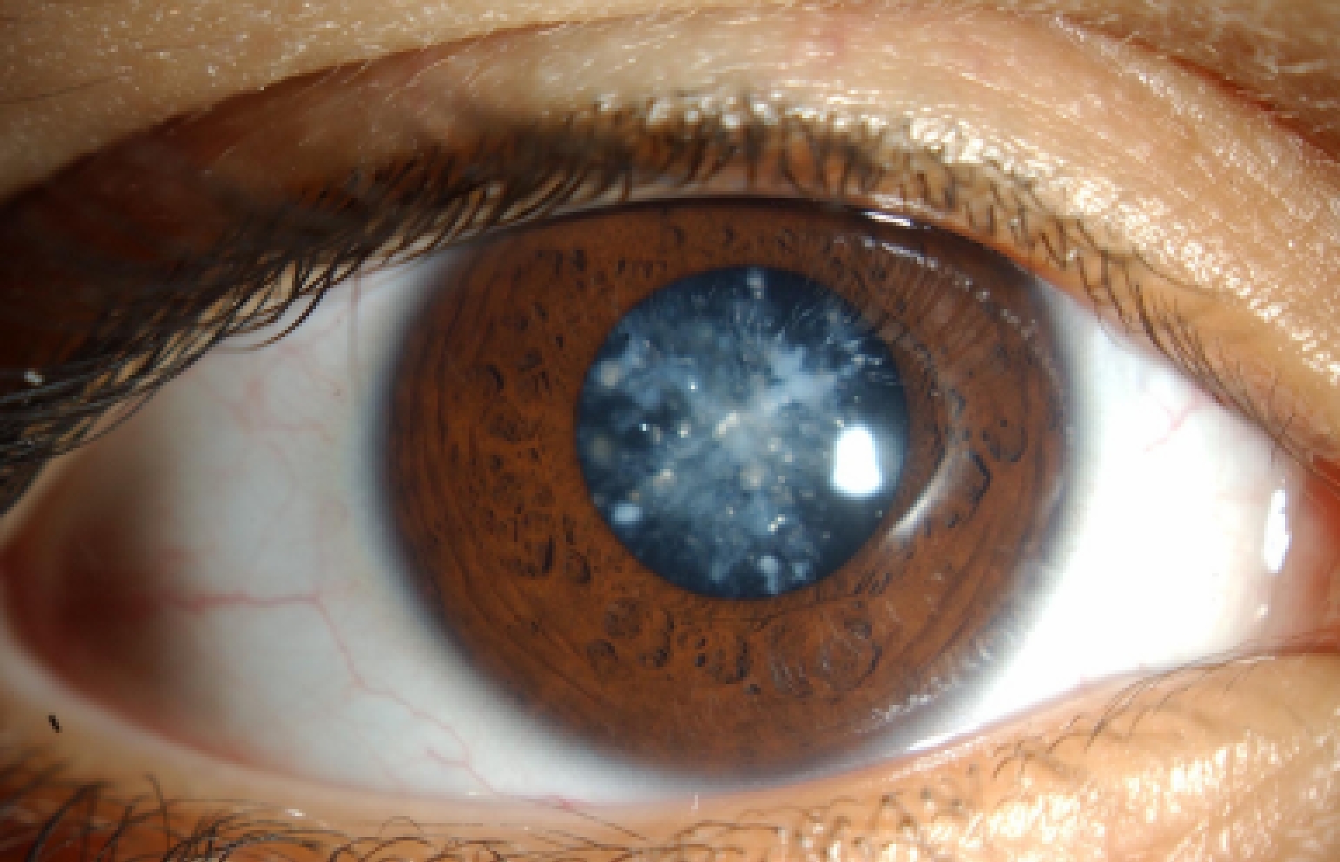 катаракта глаза